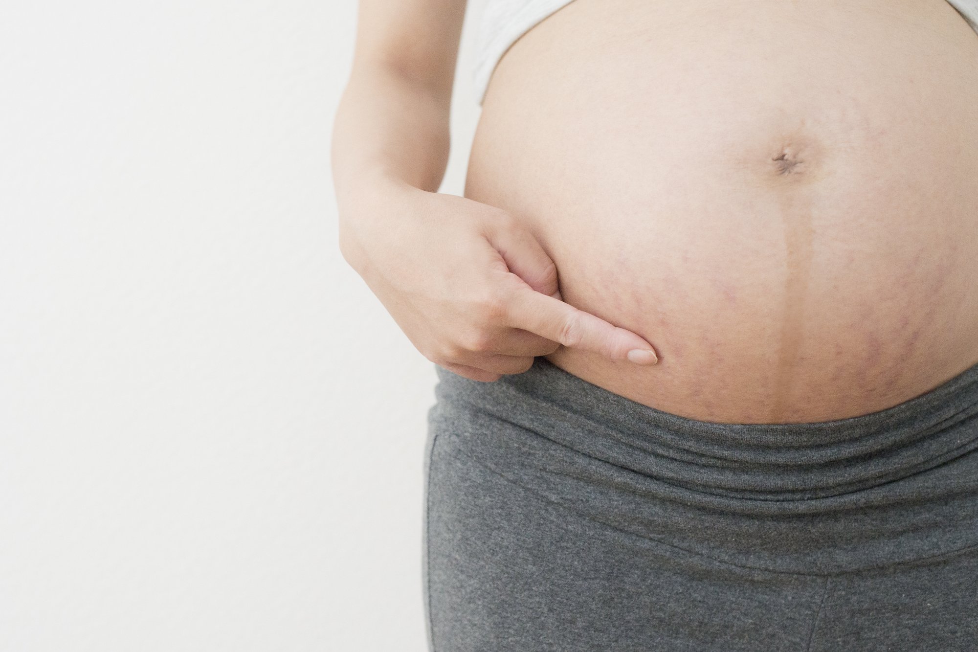 妊娠線とは? 原因・できる時期・できやすい人の特徴まとめ【助産師監修】