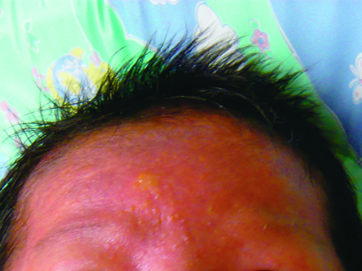 乳児脂漏性湿疹