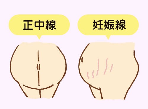 産後も消えないって本当!?意外と知らない「妊娠線」の基礎知識