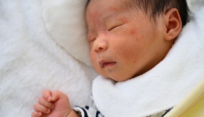 【医師監修】赤ちゃんの顔や頭にブツブツが！？新生児に多い「乳児湿疹」（脂漏性皮膚炎）の原因・予防・対処法