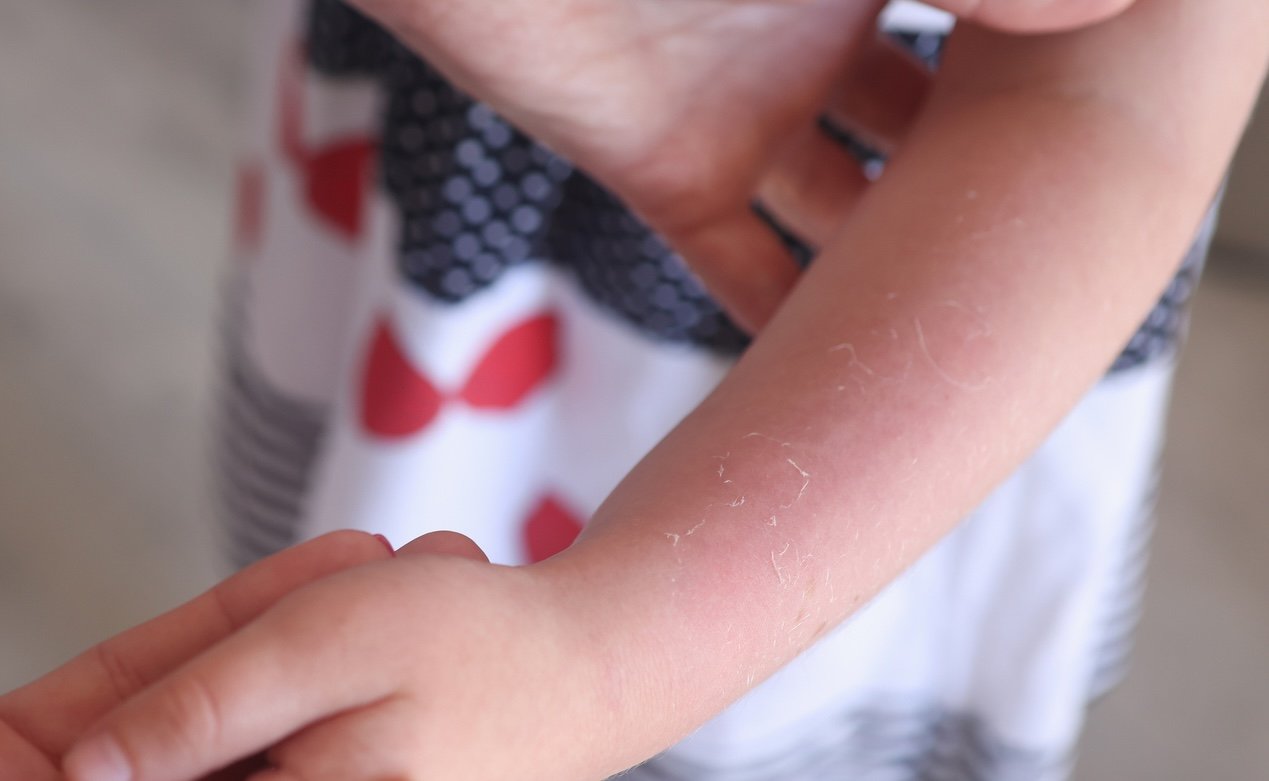 日焼けして赤くなった子供の肌