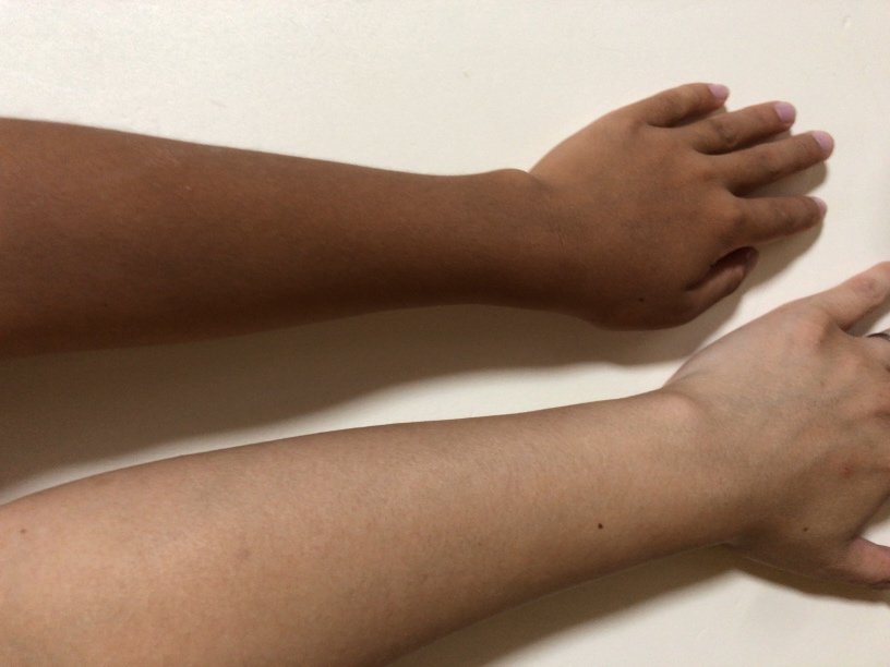 赤ちゃん・子どもの日焼け後ケア！赤み・黒くなる肌への正しい対処法と保湿