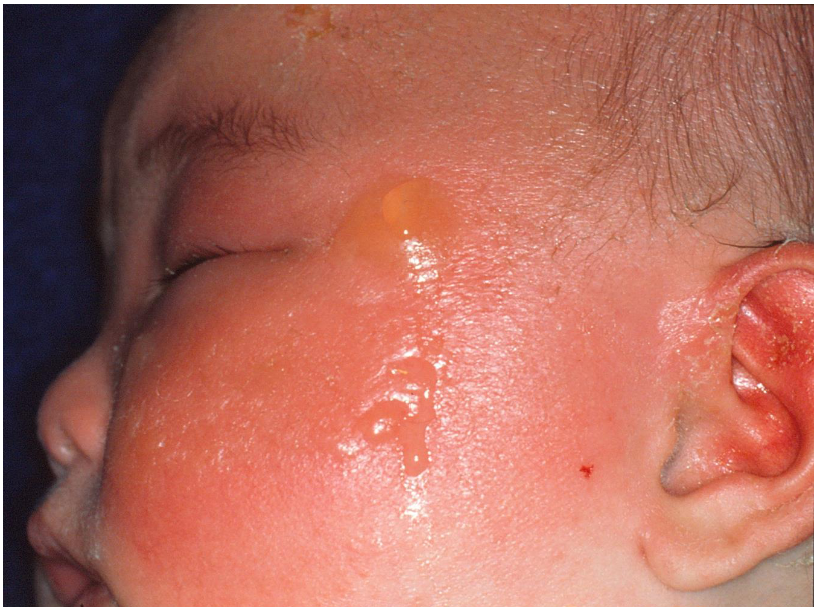 日焼けによってできた水ぶくれ