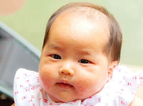 医師監修 新生児 生後0 2か月 に多い 乳児湿疹 乳児脂漏性皮膚炎 って ベビー 赤ちゃん ナチュラルサイエンス For Mama Kids Smile