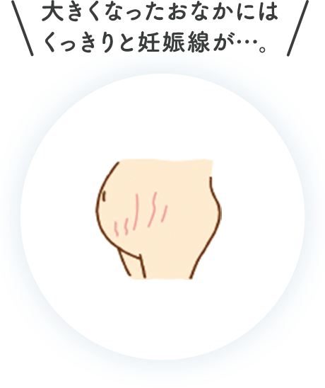 大きくなったおなかにはくっきりと妊娠線が…。