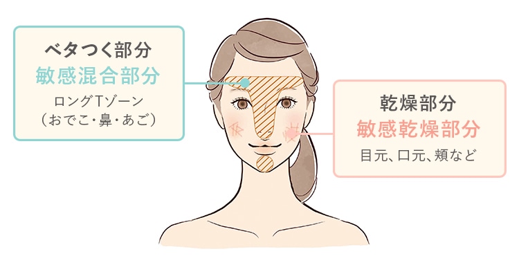 ベタつく部分（敏感混合部分）、乾燥部分（敏感乾燥部分）