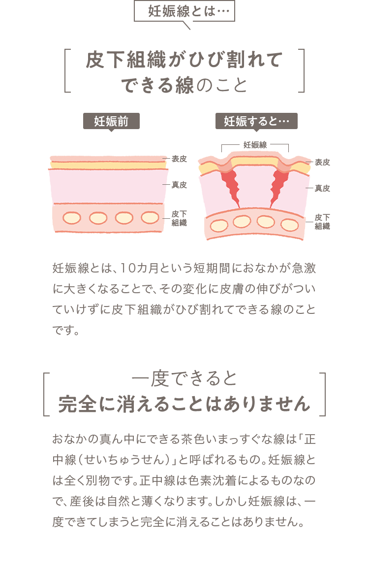 妊娠線とは… [皮下組織がひび割れてできる線のこと] 妊娠線とは、10カ月という短期間におなかが急激に大きくなることで、その変化に皮膚の伸びがついていけずに皮下組織がひび割れてできる線のことです。 [一度できると完全に消えることはありません] おなかの真ん中にできる茶色いまっすぐな線は「正中線（せいちゅうせん）」と呼ばれるもの。妊娠線とは全く別物です。正中線は色素沈着によるものなので、産後は自然と薄くなります。しかし妊娠線は、一度できてしまうと完全に消えることはありません。