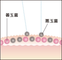 肌バリアが衰えて悪玉菌が増えた肌