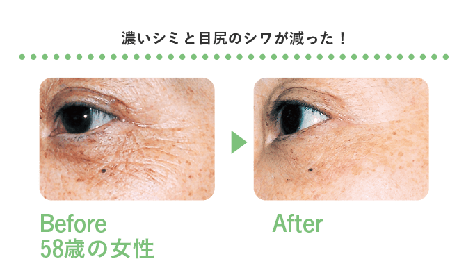 濃いシミと目尻のシワが減った!