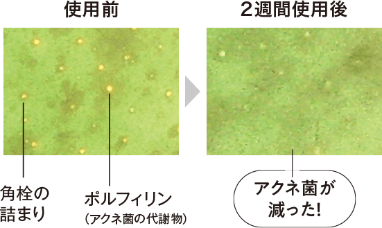 使用後のアクネ菌量