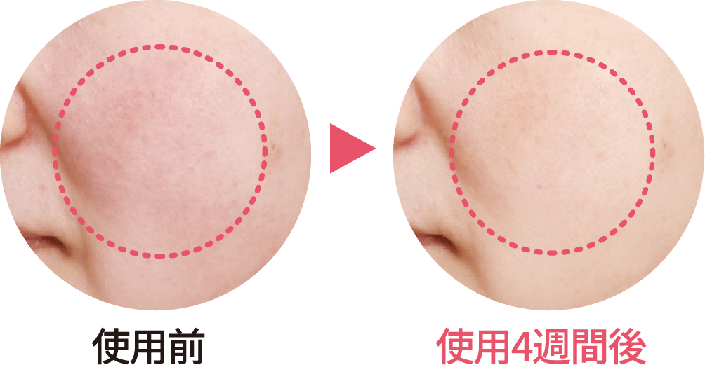 使用4週間で、赤みが減って明るい肌に！