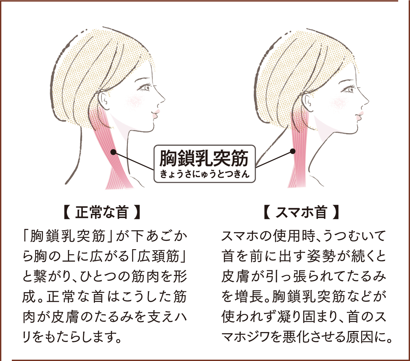 胸鎖乳突筋(きょうさにゅうとつきん)の図説 /【 正常な首 】「胸鎖乳突筋」が下あごから胸の上に広がる「広頚筋」と繋がり、ひとつの筋肉を形成。正常な首はこうした筋肉が皮膚のたるみを支えハリをもたらします。 /【 スマホ首 】スマホの使用時、うつむいて首を前に出す姿勢が続くと皮膚が引っ張られてたるみを増長。胸鎖乳突筋などが使われず凝り固まり、首のスマホジワを悪化させる原因に。